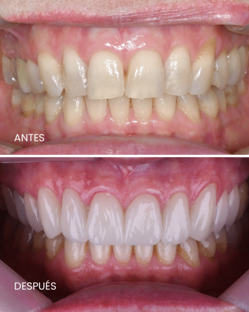 Antes y después Mónica web