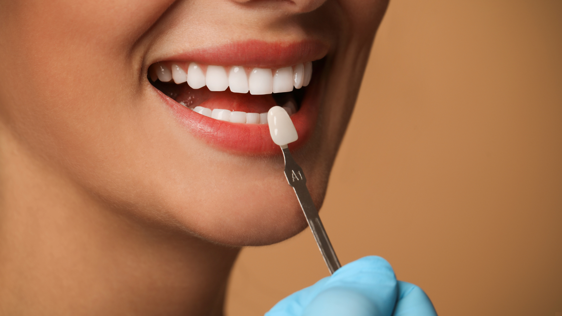 una sonrisa colocando una carilla