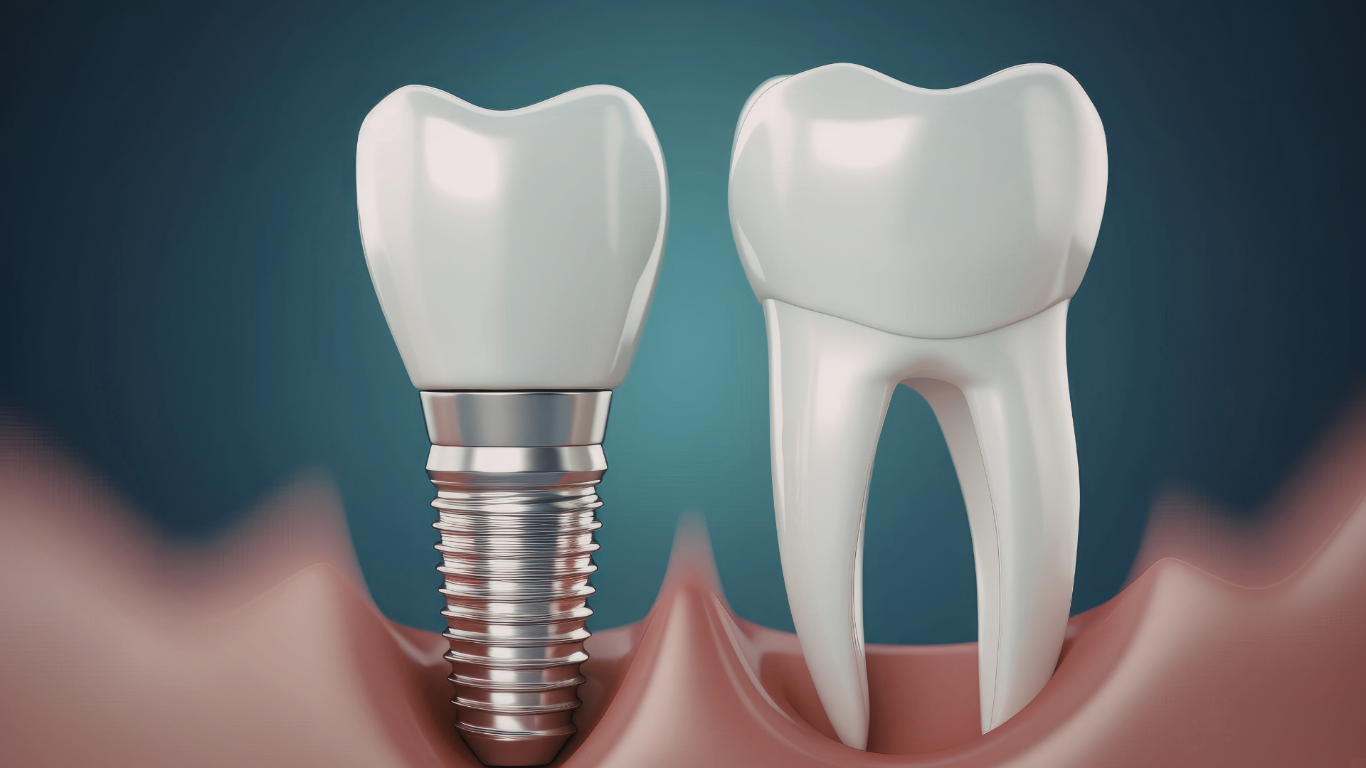 una imagen que muestra la diferencia de la forma entre un diente normal y un implante dental